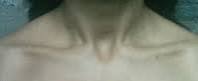 Paediactric bronchiolitis baby throat notch