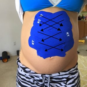 diastasis K tapping to recover a flat belly