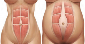 abdominal diastasis