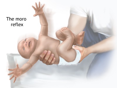 Moro reflex in new born, baby physiotherapy information, primitive reflex in infant