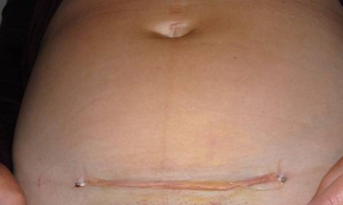 Cesarean C-Section Scar Removal Singapore - Edwin Lim Medical