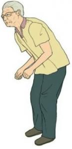 Typical anterior/flexed posture