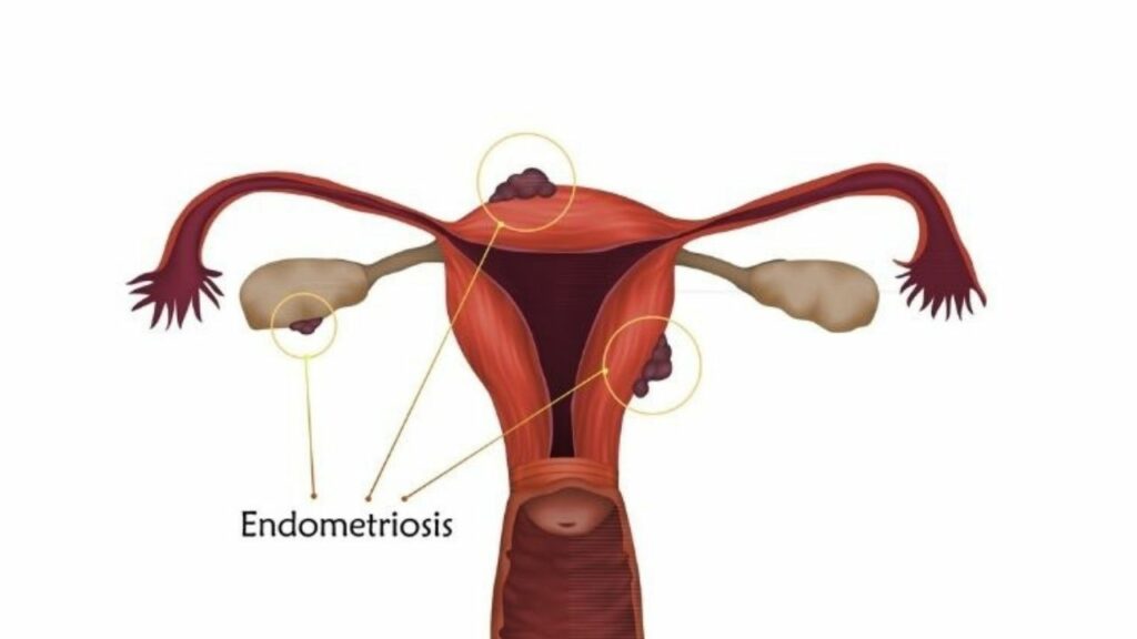 Endometriosis 1 (Women's health treatment)