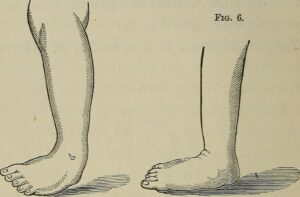 Club foot talipes in babies newborn