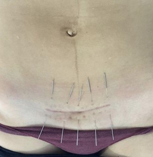 Dry needling for Women Health and C section scare