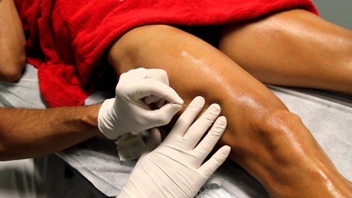 Dry needling for leg knee and joints pain