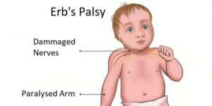 Erb Palsy physio treatment baby anatomy