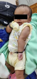 Erb Palsy physio treatment baby with paralysed arm