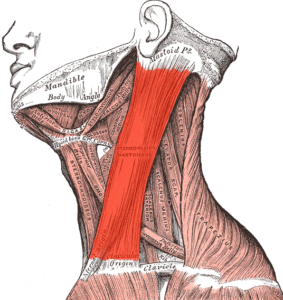 Sternocleidomastoideus congenital torticolis baby new born