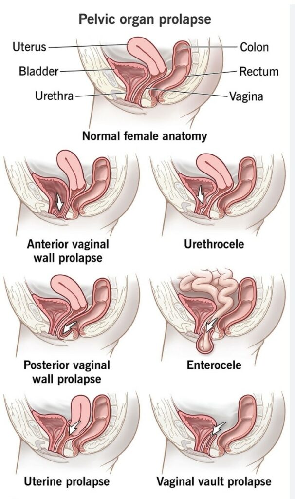 prolapsus des organes pelviens