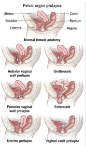 prolapse des organes pelviens