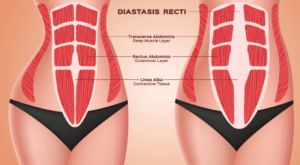 Diastasis pendant et après la grossesse
