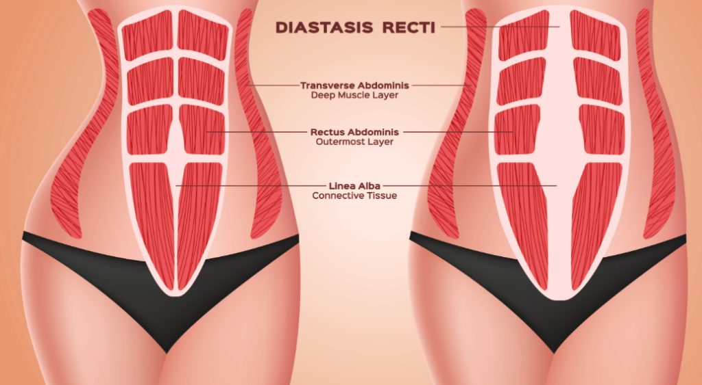 diastasis recti: pre and post pregancy